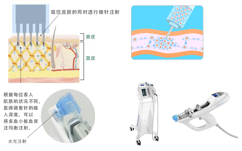 根据每位客人肌肤的状况不同，医师调整针的插入深度，可以将多血小板血浆注均衡注射。