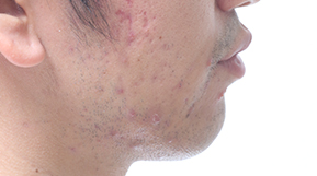 皮肤疾患的治疗