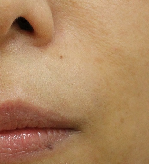 法令纹（治疗后）