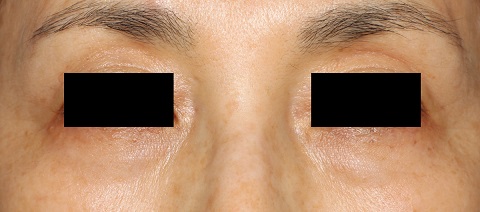 法令纹（治疗后）