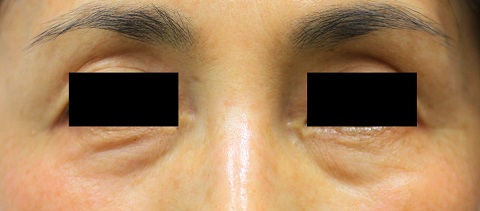 法令纹（治疗前）