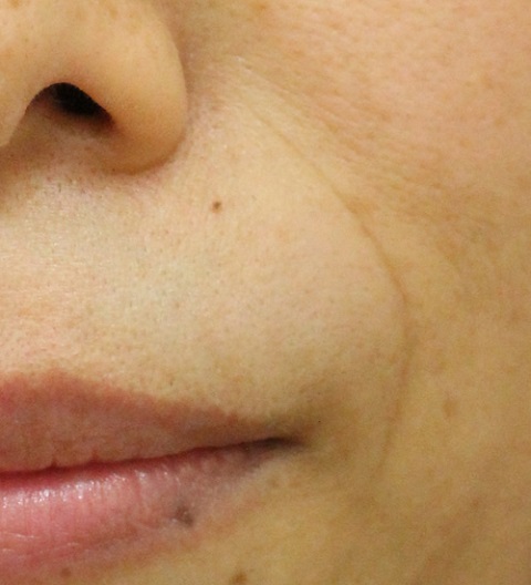 法令纹（治疗前）