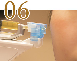 向肌肤内第一次注射细胞