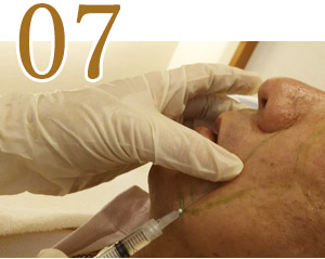 向肌肤内第二次注射细胞