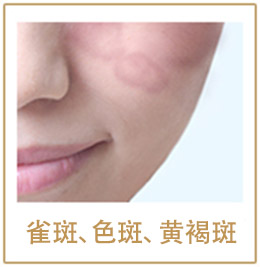 雀斑、色斑、黄褐斑
