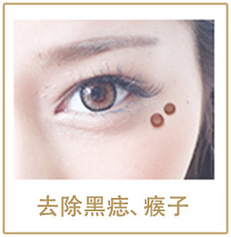 去除黑痣、瘊子